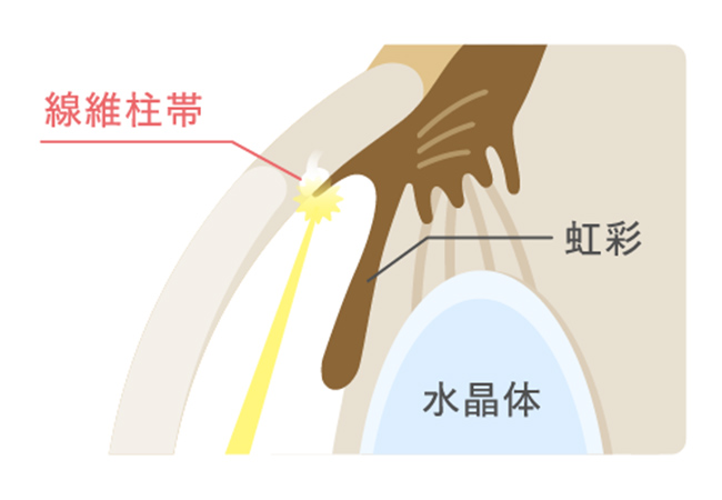 レーザー治療