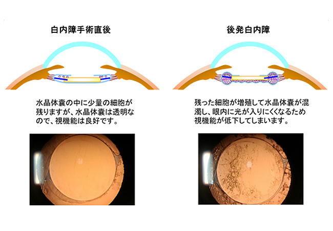YAGレーザー（後発白内障）治療