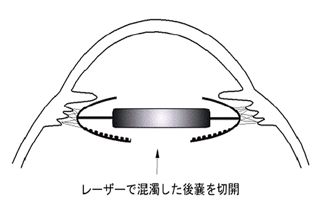 レーザーで混濁した後嚢を切開