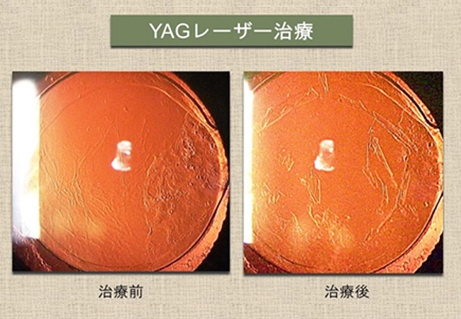 YAGレーザー治療
