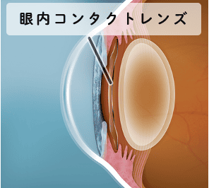 眼内コンタクトレンズのイメージイラスト
