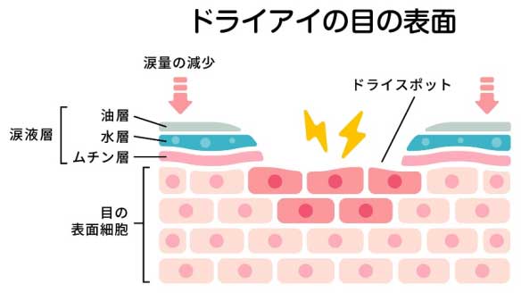ドライアイの目の表面